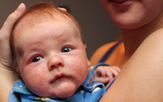 Baby Eczema Treatment: How to Soothe and Protect Your Baby’s Sensitive Skin